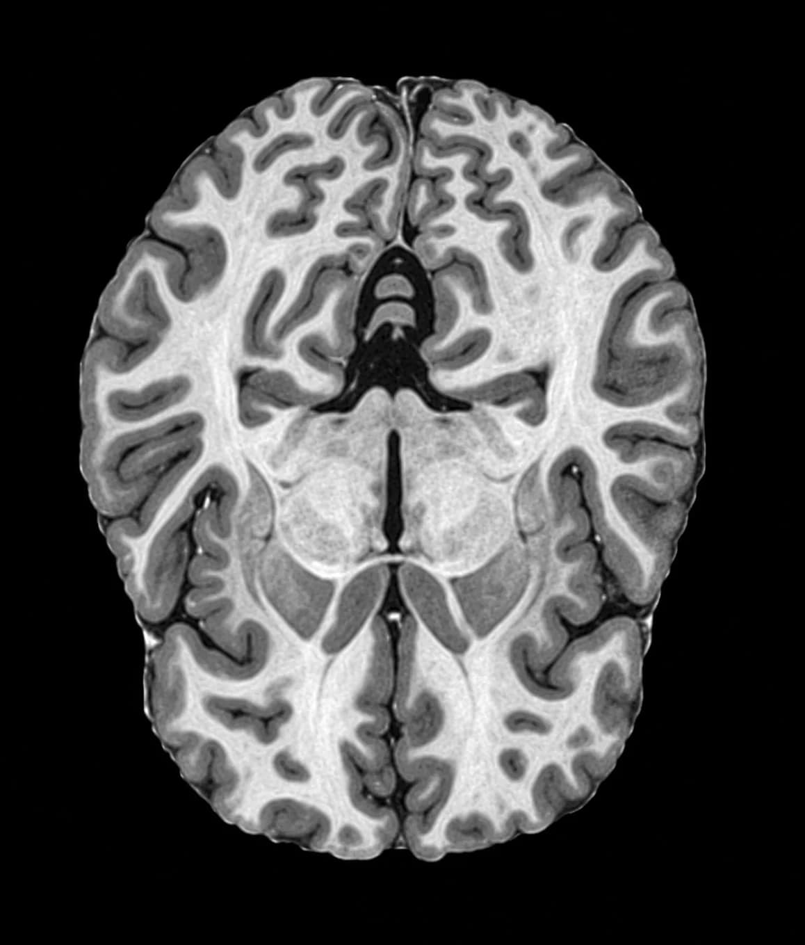 An axial MRI slice of a human brain in grayscale.